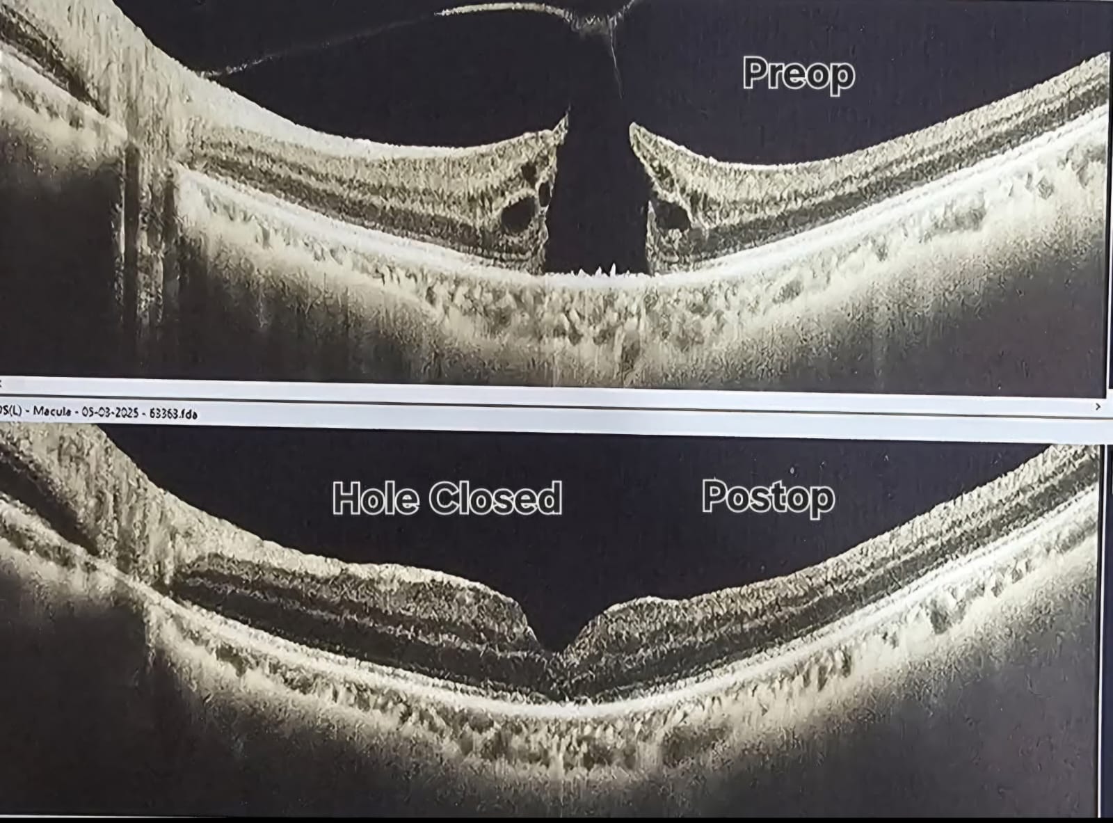 Surgery Performed - Macular Hole