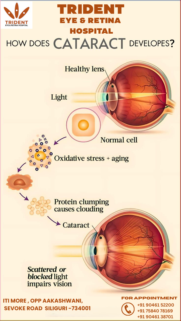 Cataract